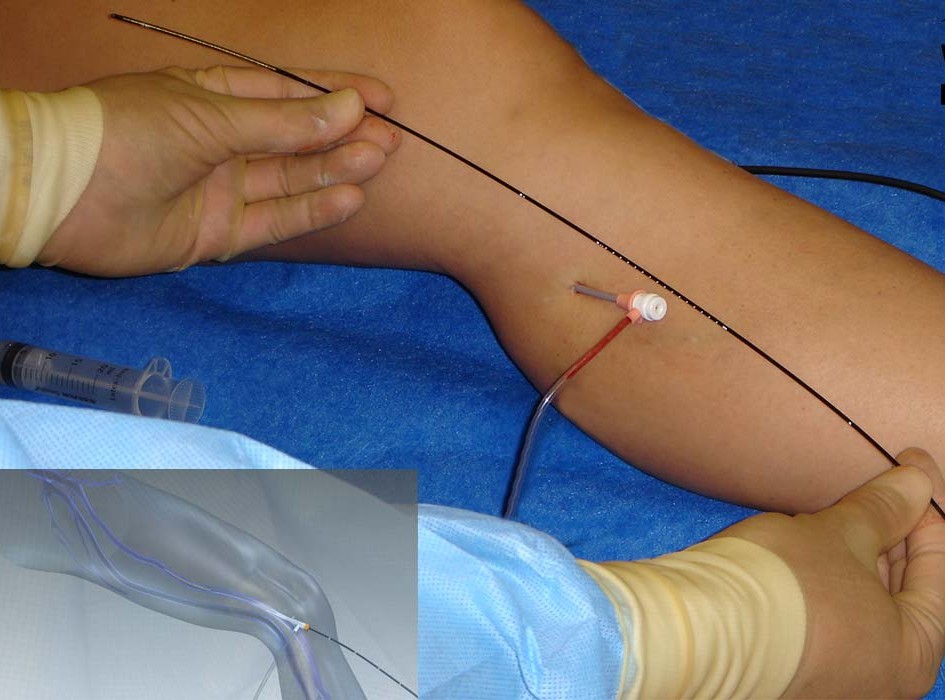 Endovenous Radiofrequency Ablation