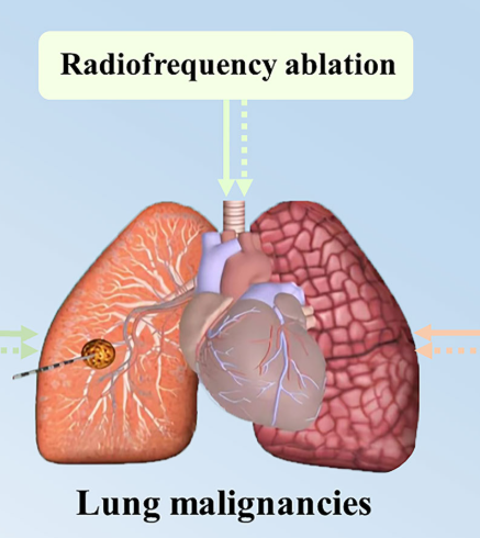 Tumor Ablation Systems